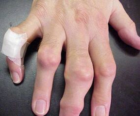прстите со заеднички деформитети предизвикуваат болка