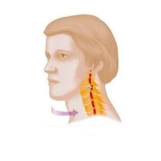 'рбетниот синдром со цервикална остеохондроза