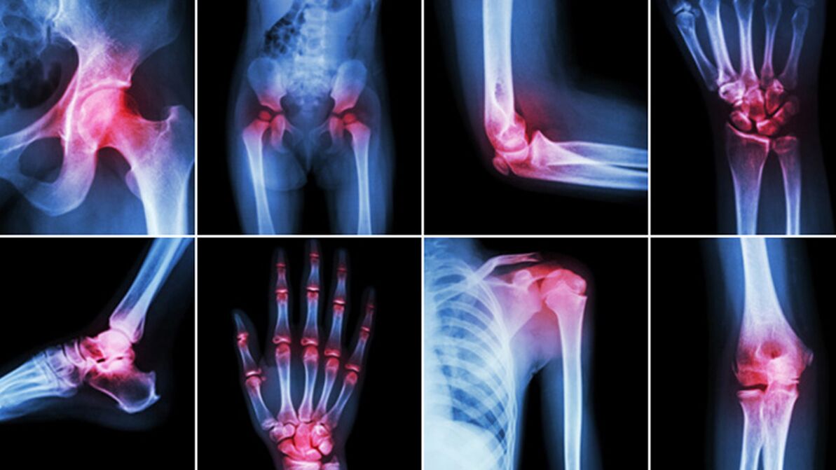 Х-зраци за болки во зглобовите