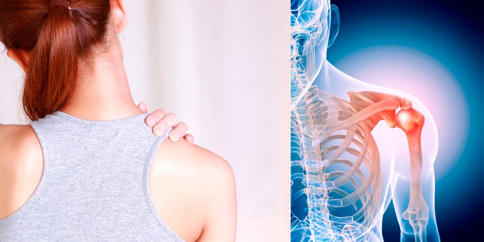 Развојот на артроза на рамото постепено доведува до постојана болка