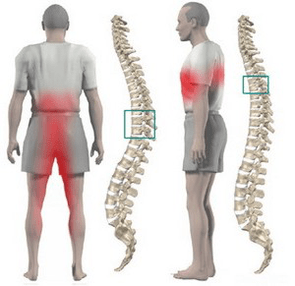 болки во грбот при торакална остеохондроза
