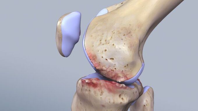 Структурата на коленото зглоб под влијание на патологија